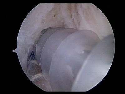 ACL Femoral Screw.jpg