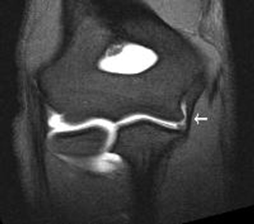 Xray of Normal UCL (white arrow, ligament is black)