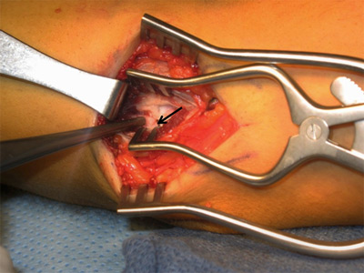 UCL is spread open allowing view of the joint