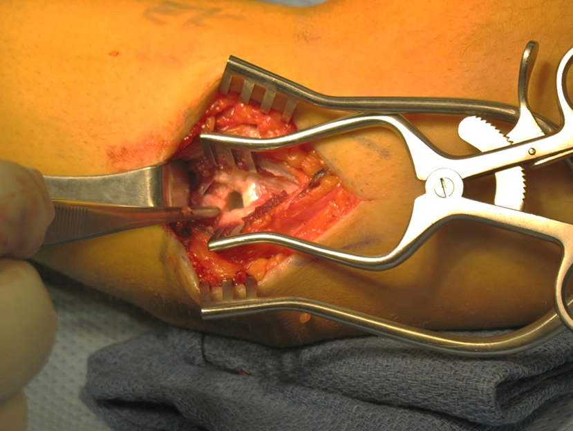 With gentle stress, the joint opens up due to the UCL tear
