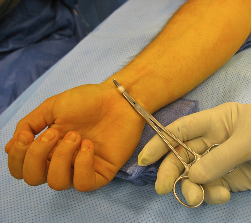 Palmaris Tendon -  UCL Reconstruction