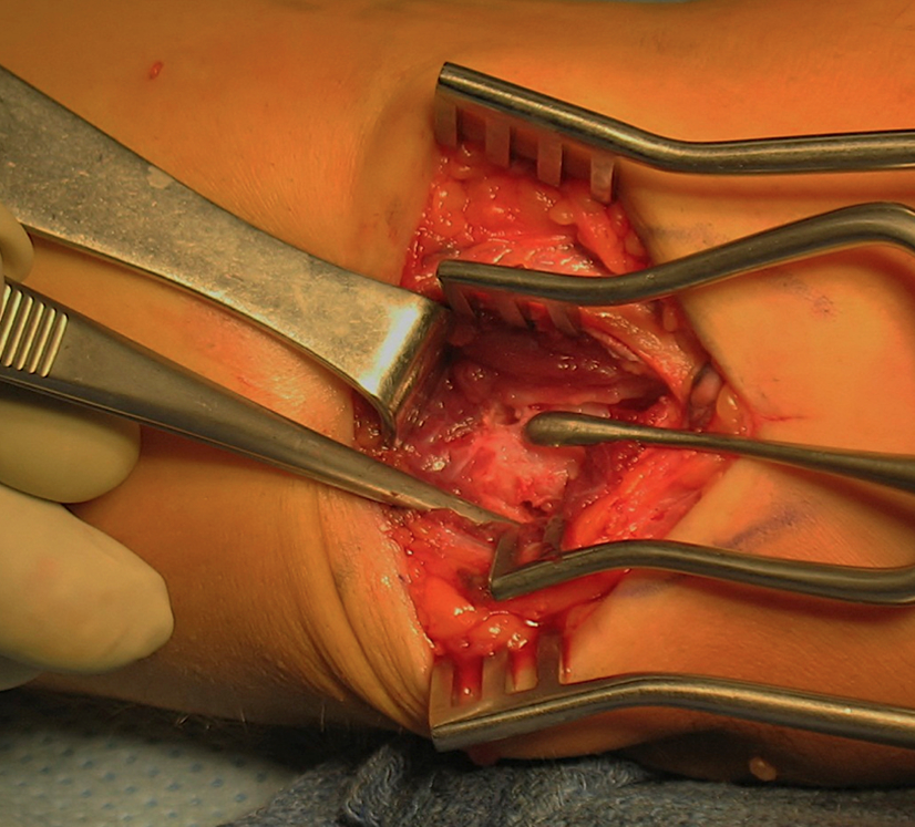 UCL Reconstruction - Close up of completed tunnels in Ulna