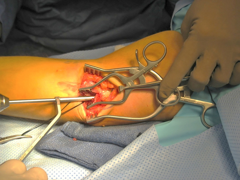 Tunnel drilled in the medial epicondyle of the humerus