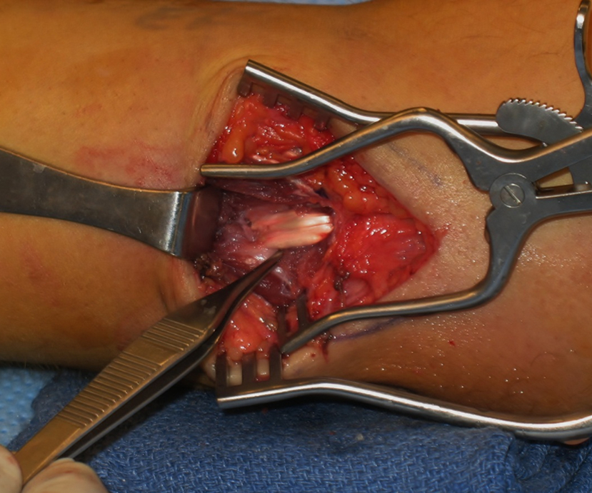 Tommy John Surgery - UCL Graft in place
