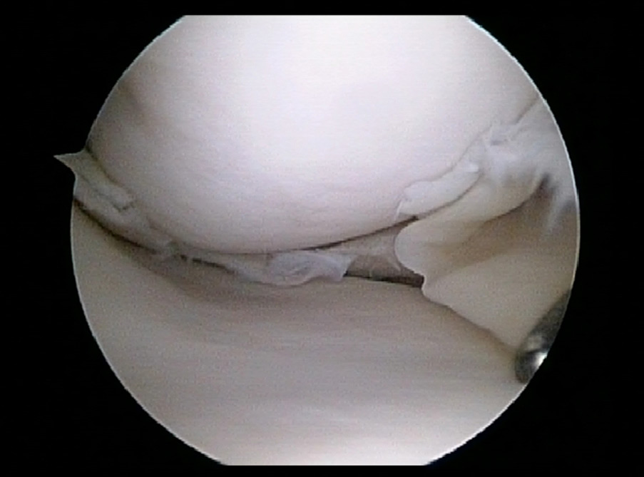 Flap Tear of Medial Meniscus