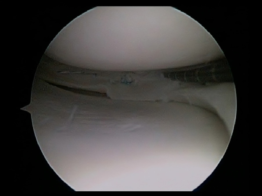Repaired Meniscus